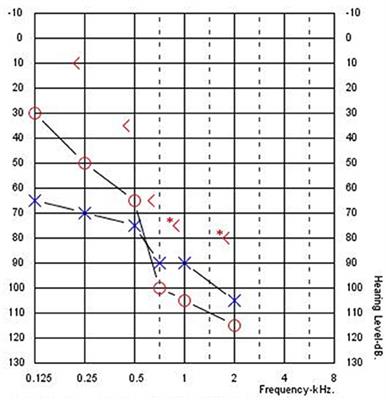 An Objective Estimation of Air-Bone-Gap in Cochlear Implant Recipients with Residual Hearing Using Electrocochleography